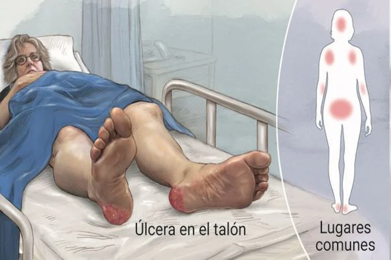 Imagen representativa sobre el control de Úlceras
